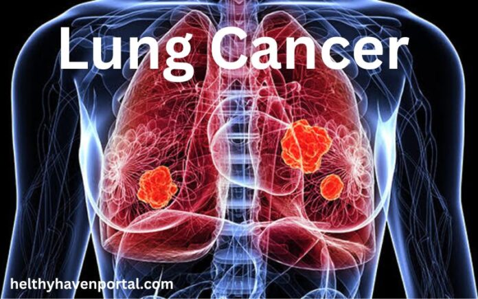 Lung Cancer